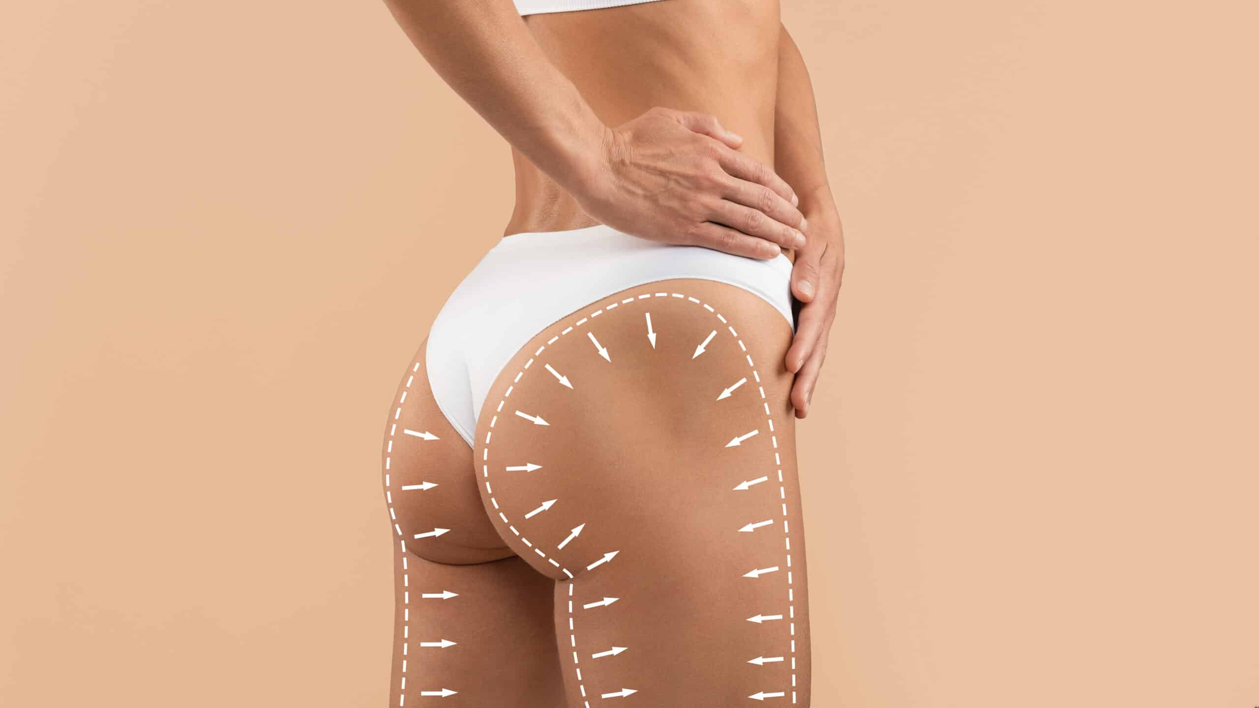 Silhouette latérale d'une femme en sous-vêtements blancs, montrant un traitement amincissant des fesses et des cuisses indiqué par des flèches blanches.
